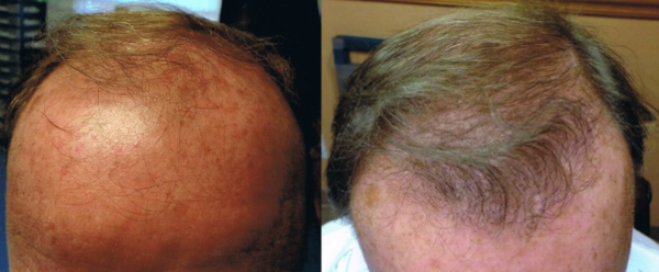 ARTAS hair restoration before and after results