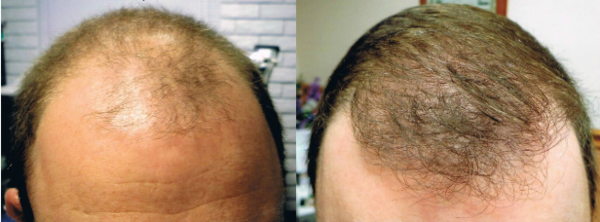 ARTAS before and after results