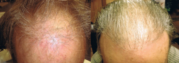 ARTAS hair transplant before and after