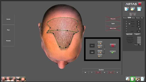 Creating the ideal hairline with the ARTAS robotic hair transplant system