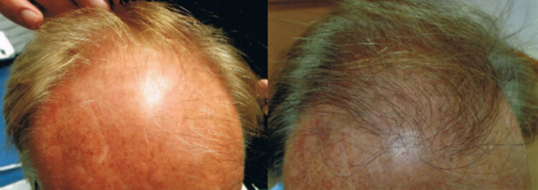 ARTAS Robotic hair transplant before and after