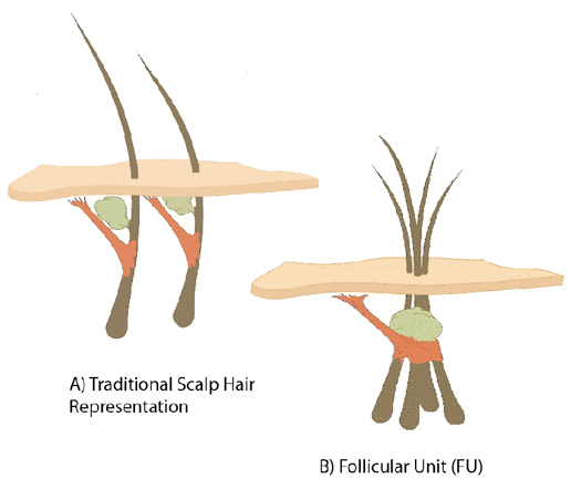 follicular unit hair graft
