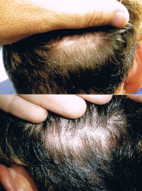 Does the fut hair transplant leave a scar?