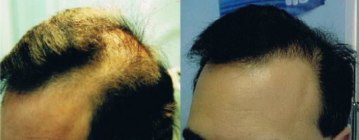 FUT hair transplant method
