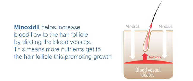 How rogaine minoxidil works as a hair loss treatment