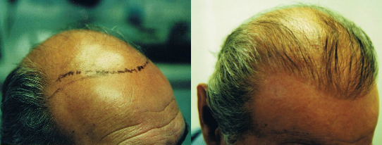 neograft hair transplant before and after