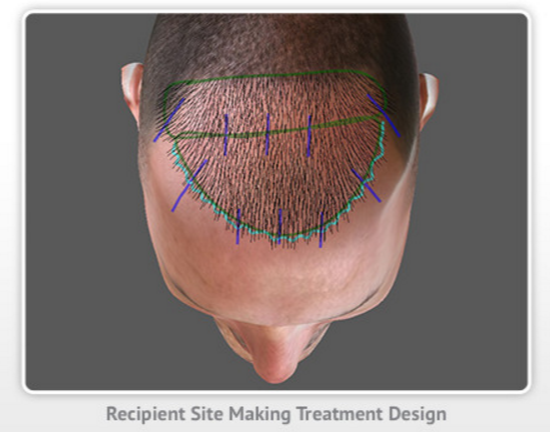 ARTAS hair restoration design for maximum hair growth