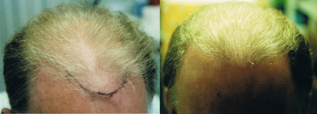 topical stem cell treatment for hair loss