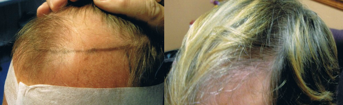 ARTAS hair transplant tampa before and after results