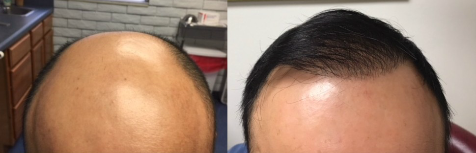 ARTAS hair transplant before and after photos by Tampa Bay Hair Restoration in Florida.