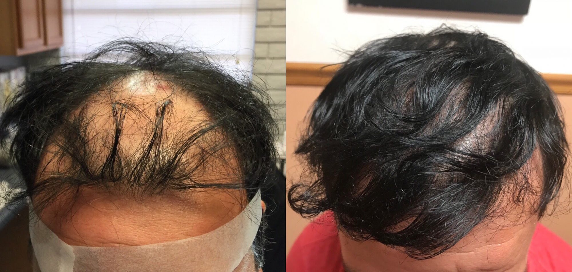 Fut Hair Transplant Average Cost Procedure Results More Tbhr